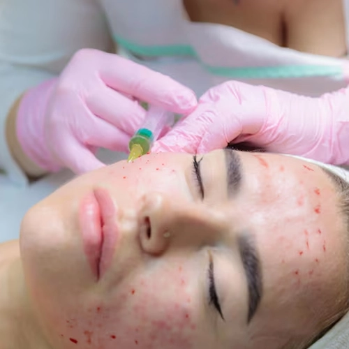 Acne Marks