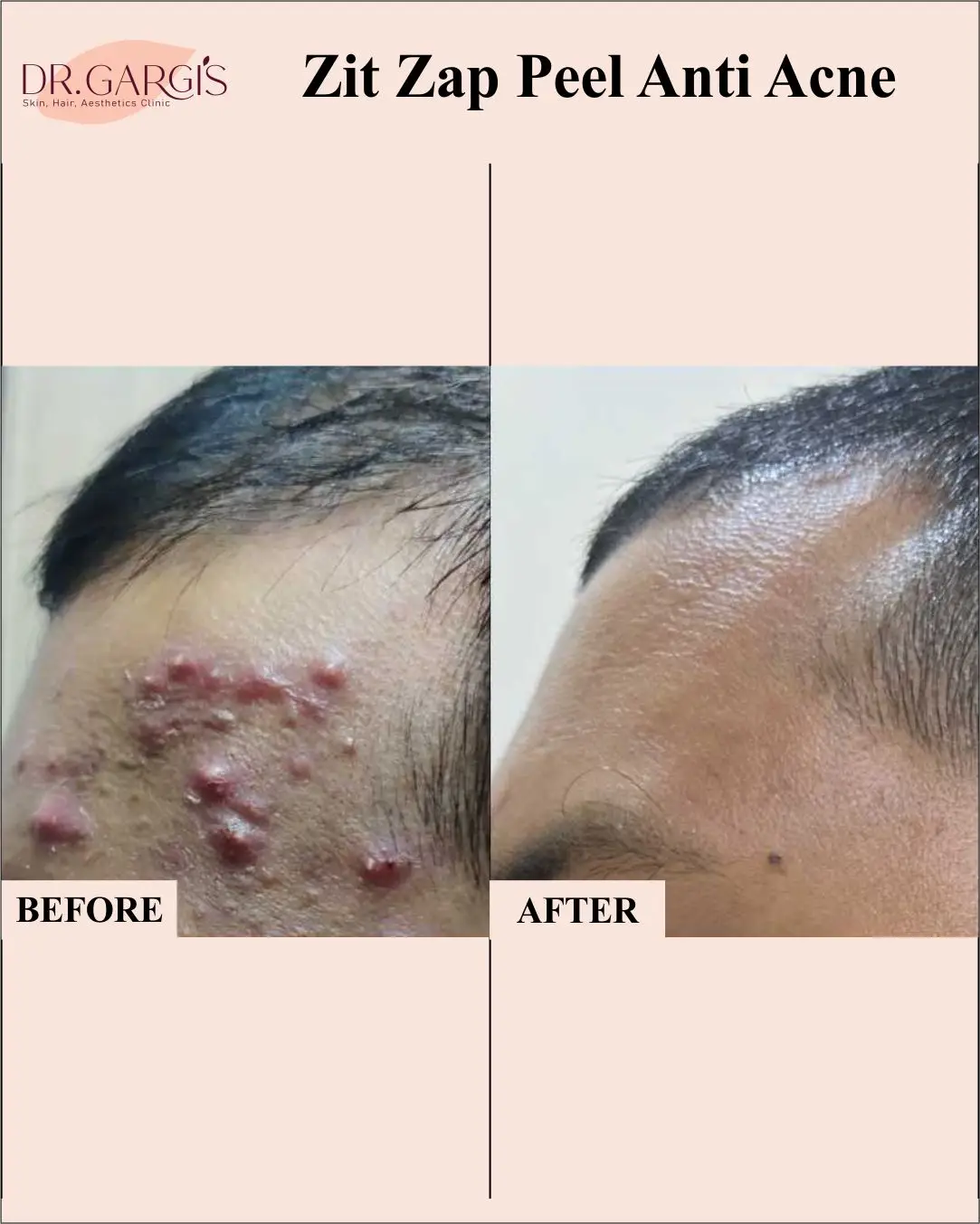 Before and After Result 4
