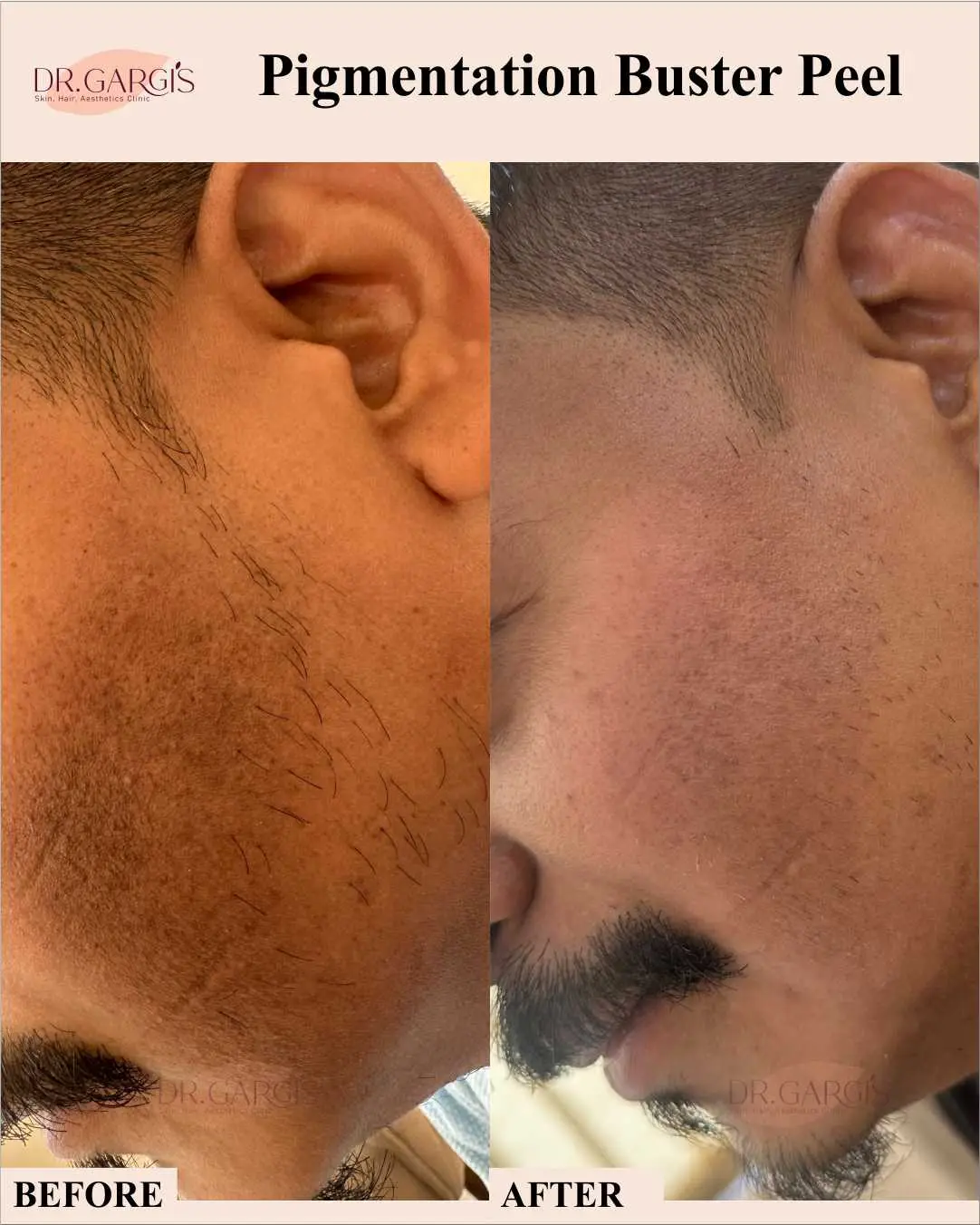 pigment-peel-treatment-in-gurgaon