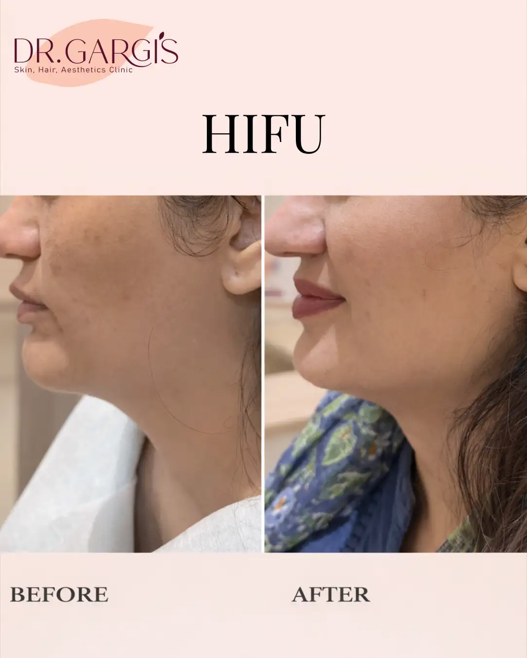 HIFU