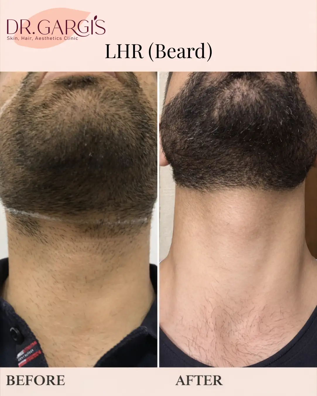 LHR-Beard