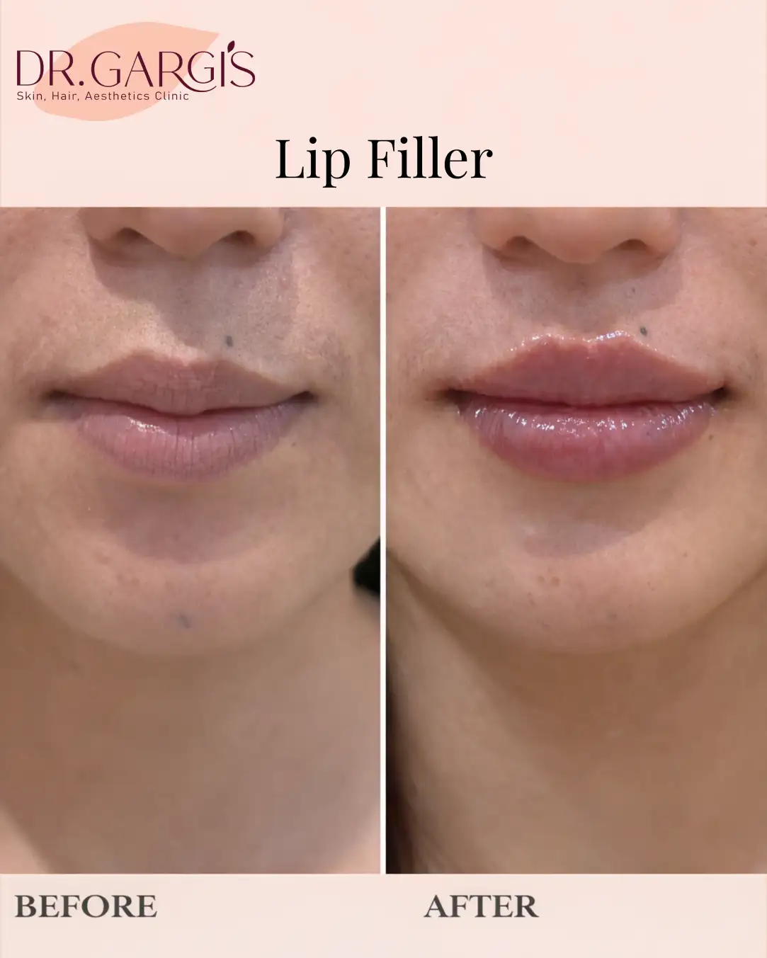 Lip-Filler