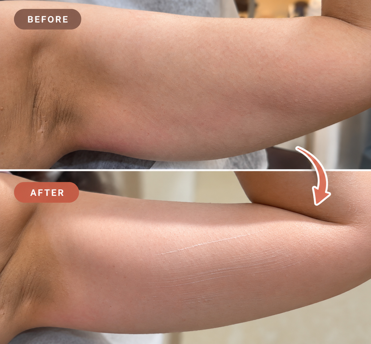 Before and after underarm skin smoothing